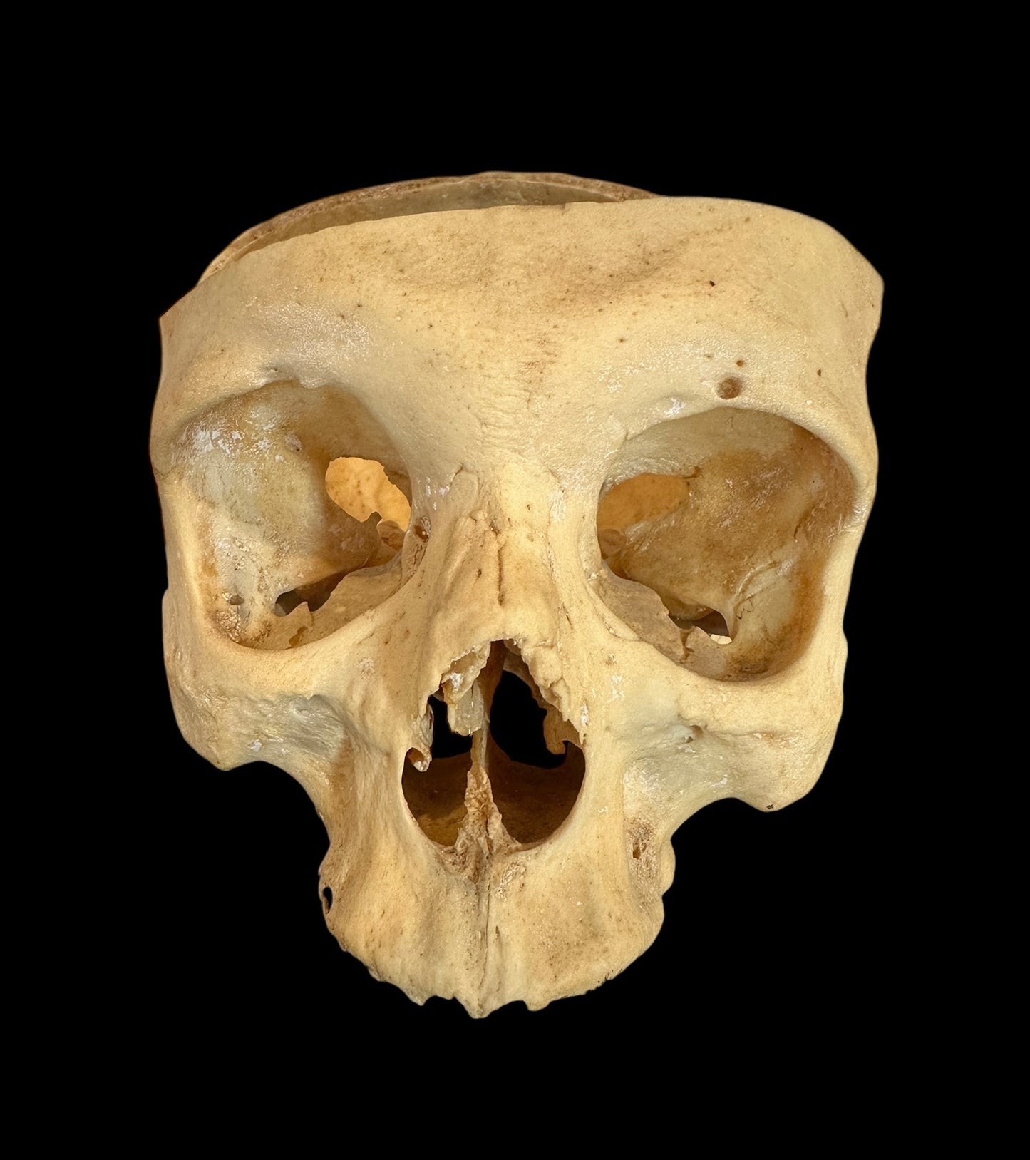 Human Skull Cranium  Autopsy Cut