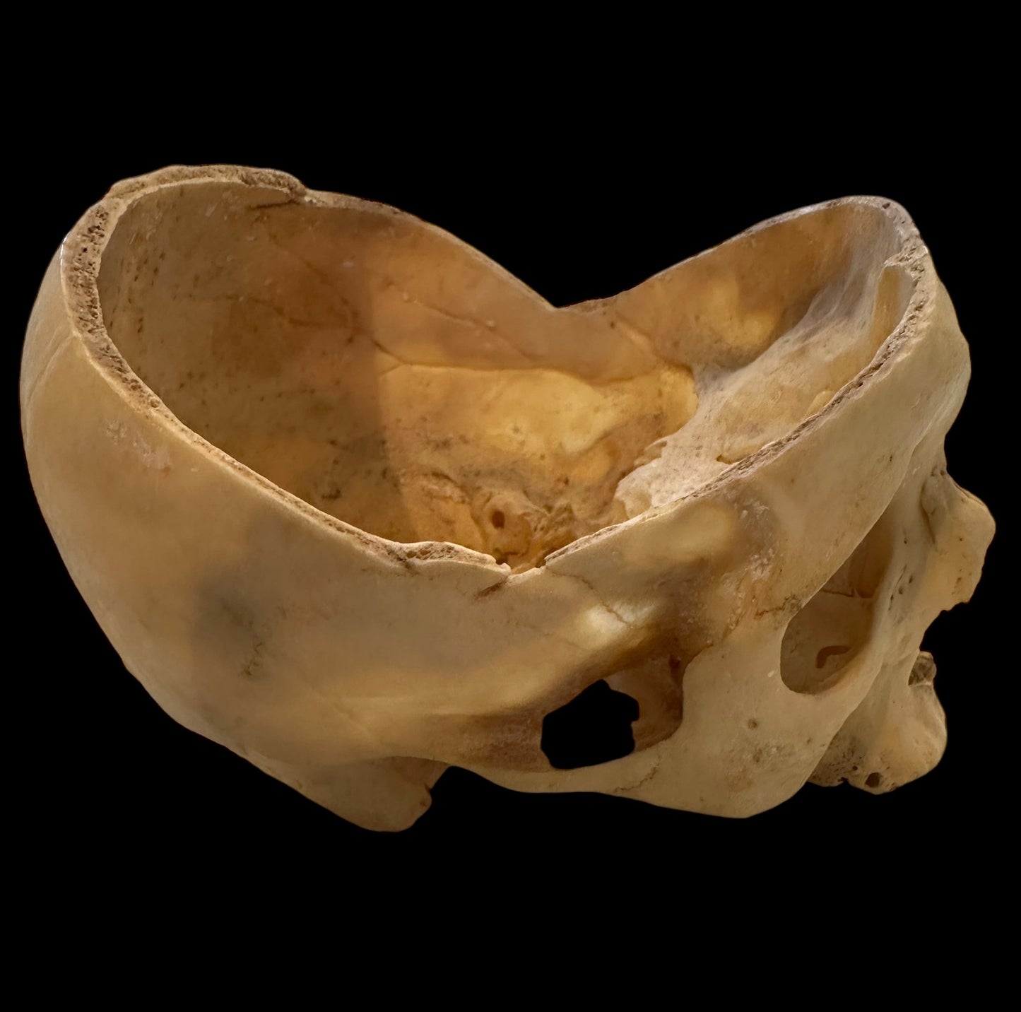 Human Skull Cranium  Autopsy Cut